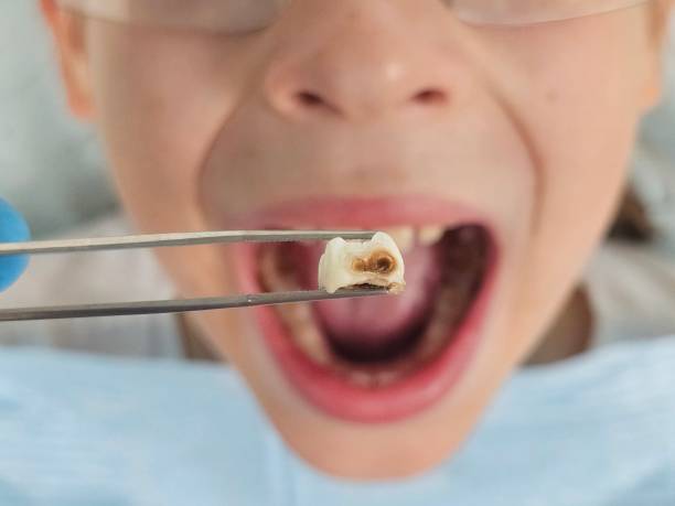 Best Root Canal Emergency Dentist  in Compton, CA
